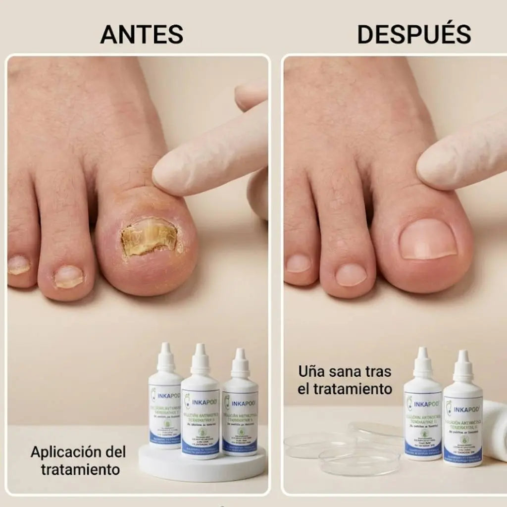 Terbinafina Gotas – Solución Antimicotica 60ml